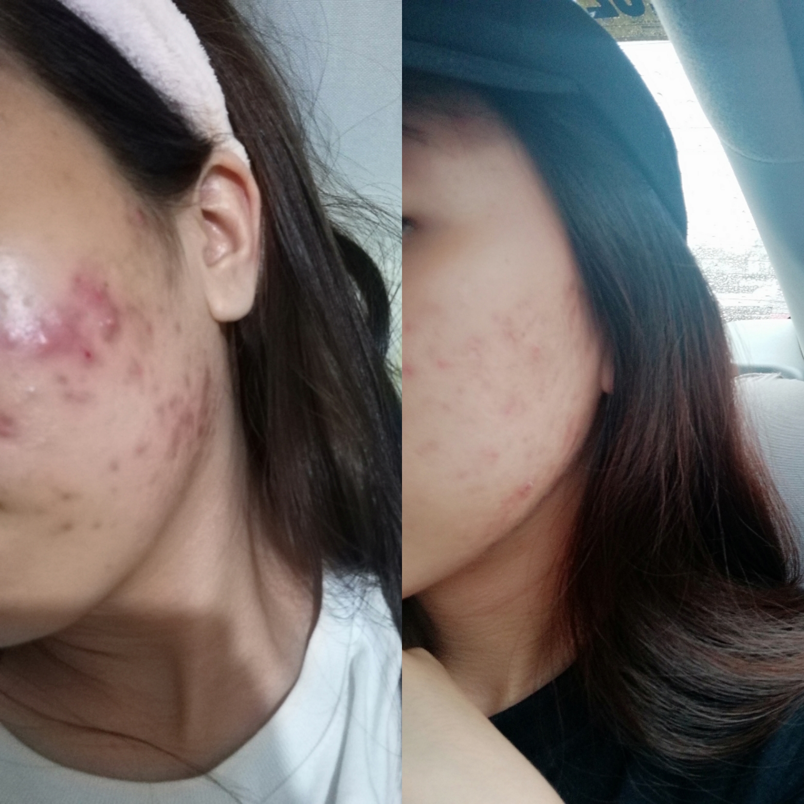 How I cured my acne and acne scars through Korean Skincare – Annyeong